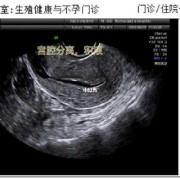 孕期宫腔积液怎么排出（孕期宫腔积液）
