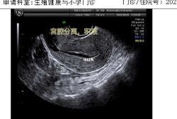 孕期宫腔积液怎么排出（孕期宫腔积液）