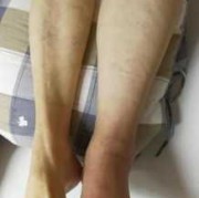 怀孕期间血栓（怀孕期间血栓会有什么后果）