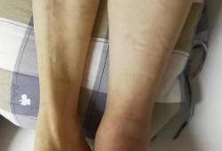 怀孕期间血栓（怀孕期间血栓会有什么后果）