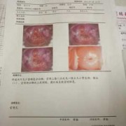 宫颈短卧床休息能长长吗,孕期宫颈短怎么长上去 20周