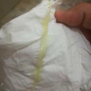 孕期白带什么颜色正常