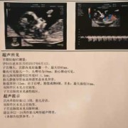 怀孕12周nt12胎儿颈部水囊瘤水肿怎么办,胎儿为什么会水肿和水囊瘤