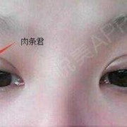 胎儿双眼皮（胎儿双眼皮是几个月形成的）