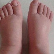 孕期水肿生女儿吗（孕期为什么会水肿）