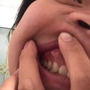 孕期牙龈增生怎么办（孕期牙龈增生怎么办）