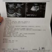 胎儿胆囊下（我怀孕36周+4天了检查的胎儿胆囊大小约28.7*8.2mm正常吗）