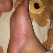 孕期脚面痒（孕期脚面痒越抓越痒咋回事）