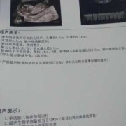 nt图片胎儿（NT结果怎么看）