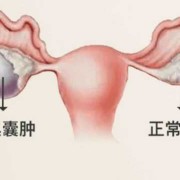 孕期卵巢囊肿（孕期卵巢囊肿影响胎儿吗）
