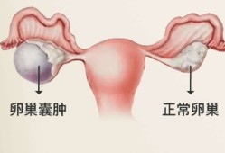 孕期卵巢囊肿（孕期卵巢囊肿影响胎儿吗）
