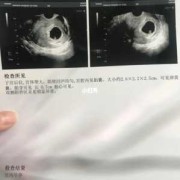 胎囊和胎儿（孕囊就是宝宝吗）