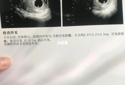 胎囊和胎儿（孕囊就是宝宝吗）