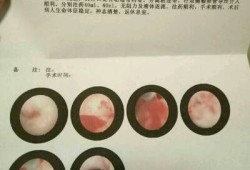 孕期出血宫腔有激液怎么办,孕期持续流血胎儿一切正常