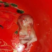 胚胎停育有什么症状,孕早期胎儿停育有什么症状
