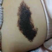 胎儿胎记是什么原因造成,胎儿长胎记的原因有哪些呢?