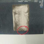 宝宝练习趴着抬头翻过来怎么翻,四维胎儿趴着怎么尽快转身