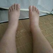 孕期腿脚浮肿（孕妇脚水肿怎么办）
