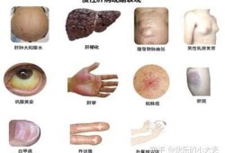 孕期黄疸（孕期黄疸的症状表现）