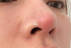孕期鼻头变红（孕期鼻头变红是什么原因）