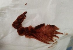 孕期上厕所大便出血（孕妇便秘，拉大便好多血是怎么回事呢）