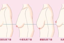 孕期胸变软（孕期胸变软）