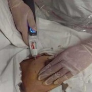 乳腺肿块微创手术前要检查什么,孕期微创检查是什么?
