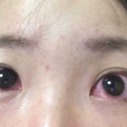 怀孕期间眼睛红怎么办（怀孕期间眼睛红怎么办呢）