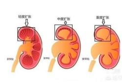 胎儿缺肾（胎儿缺肾是怎么形成的）