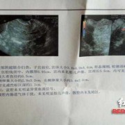 孕期体检时间及项目（怀孕做B超，做两次B超的间隔时间应该是多长）