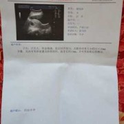 怀孕16周胎儿彩超（怀孕十六周做腹部彩超显示胎心163正常吗）