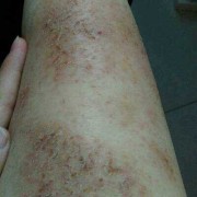 孕期皮肤病（孕期皮肤病看妇科还是皮肤科）