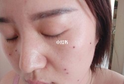 孕期可以点痣吗（孕期可以点痣吗脸上）
