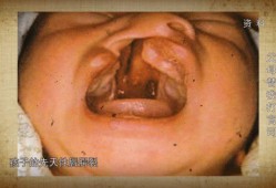 唇腭裂宝宝是怎么造成的,胎儿为什么会唇腭裂的原因