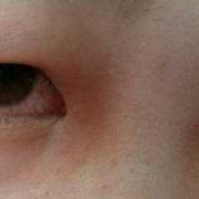孕期眼睛发红（眼睛发红是什么病）