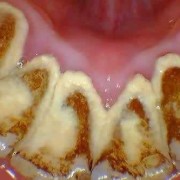 孕期牙结石（孕期牙结石）