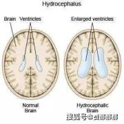 导液管是什么东西,胎儿脑导水管形成时间