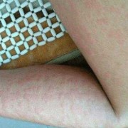 孕期 荨麻疹（孕期荨麻疹痒的受不了怎么办）