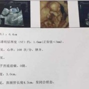 孕期nt检查（孕期nt检查什么项目）