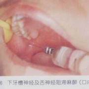 局部麻药胎儿会畸形吗（局部麻药胎儿会畸形吗）