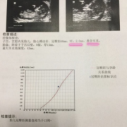 产检中说的nt到底是什么意思,孕期NT是什么检查