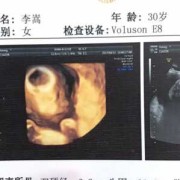 24周胎儿有多大,怀孕24周胎儿彩超图片