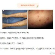 怀孕五个月，肚皮上长很多小红点，特别痒该怎么办,孕期肚子有红点点不痒