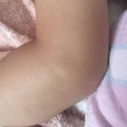为什么宝宝胳膊腿上总是一块块的跟橘子皮一样的皮,胎儿腿偏短怎么补救