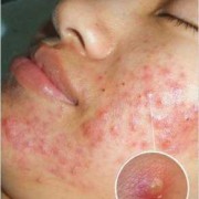孕期挤痘痘（孕妇脸上长了很多痘痘，里面有些脓，挤掉以后可以用酒精消炎吗）