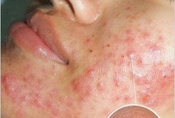 孕期挤痘痘（孕妇脸上长了很多痘痘，里面有些脓，挤掉以后可以用酒精消炎吗）