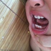 胎儿鹅口疮能治好吗（胎儿鹅口疮好治疗吗）