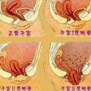 孕期子宫脱垂的症状（孕期子宫脱垂的症状是什么）