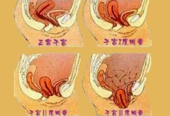 孕期子宫脱垂的症状（孕期子宫脱垂的症状是什么）