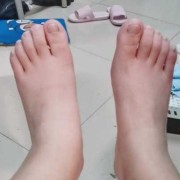 脚胖是哪样的,孕期脚胖了还能恢复吗